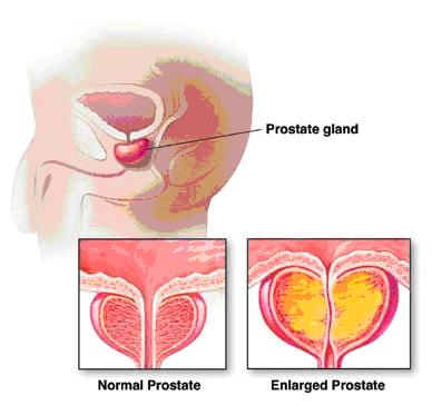 Perbedaan antara Prostat yang Normal dengan Prostat yang bermasalah