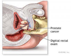 Gambar Prostat yang bermasalah dan harus segera dicari solusi penyembuhannya